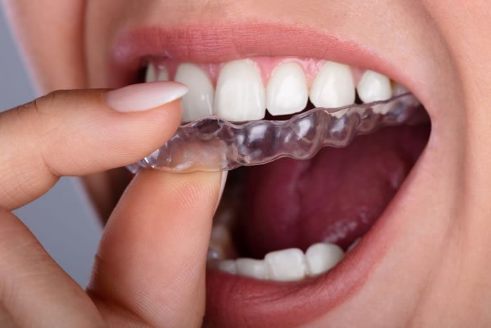 Bruxism Treatment in Istanbul