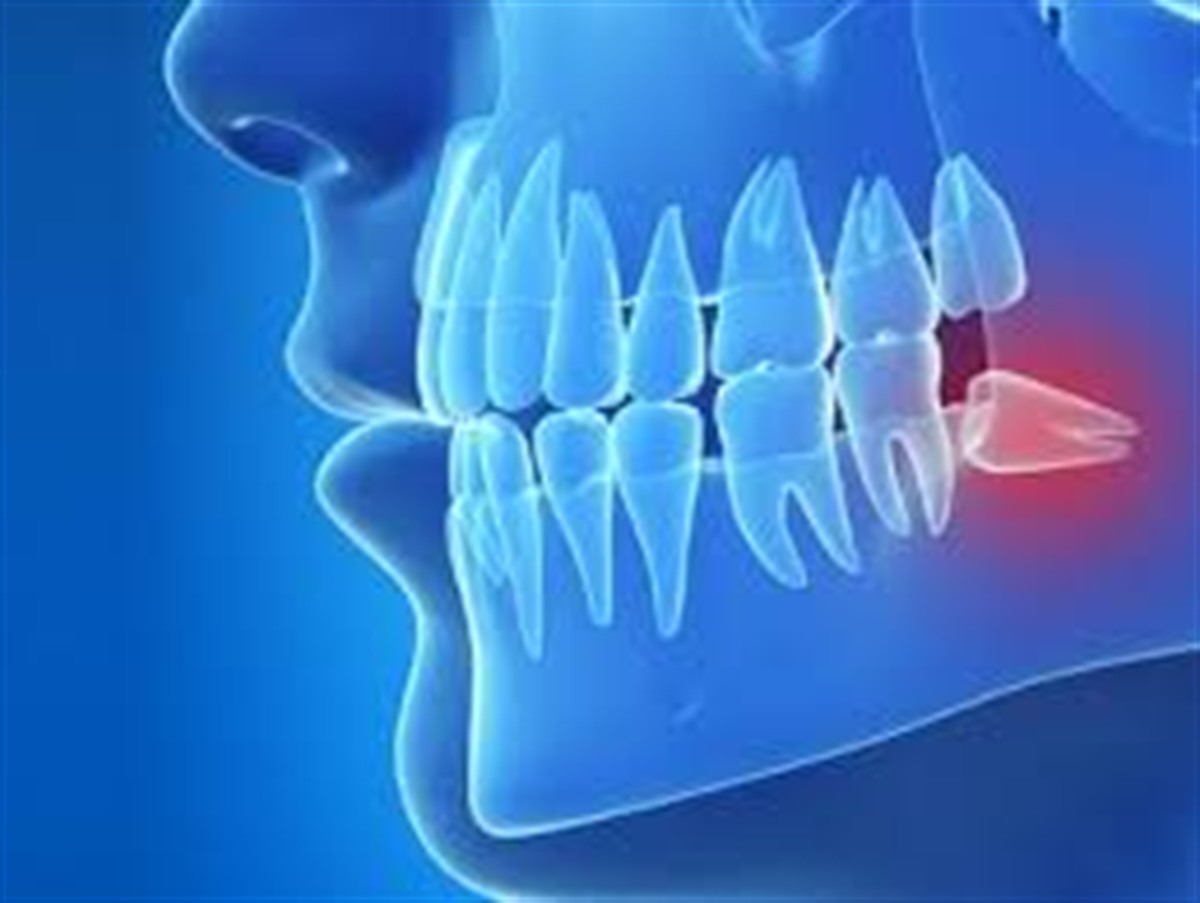 Extraction of an Impacted Wisdom Tooth in Istanbul