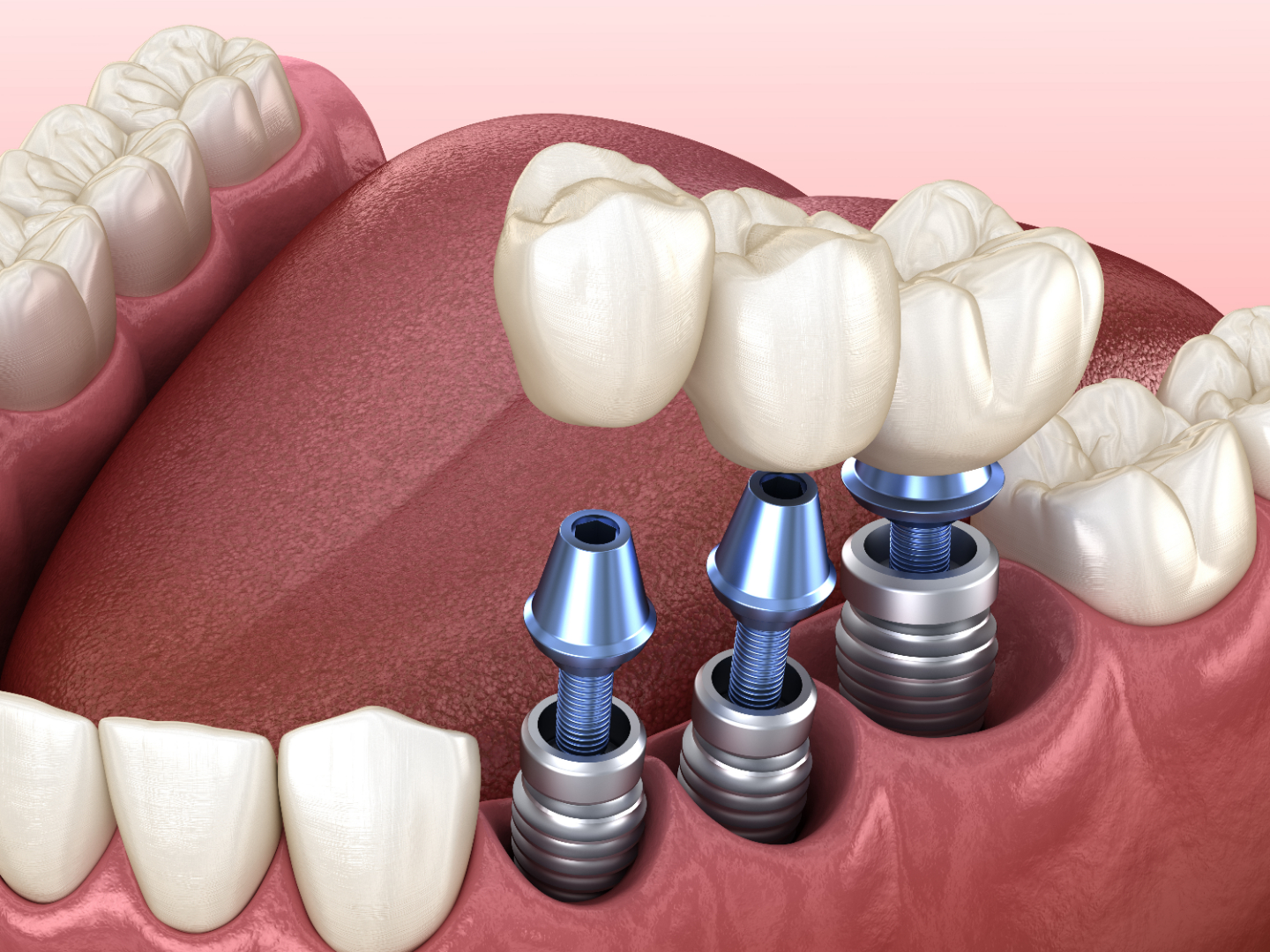 Implant Treatment Process