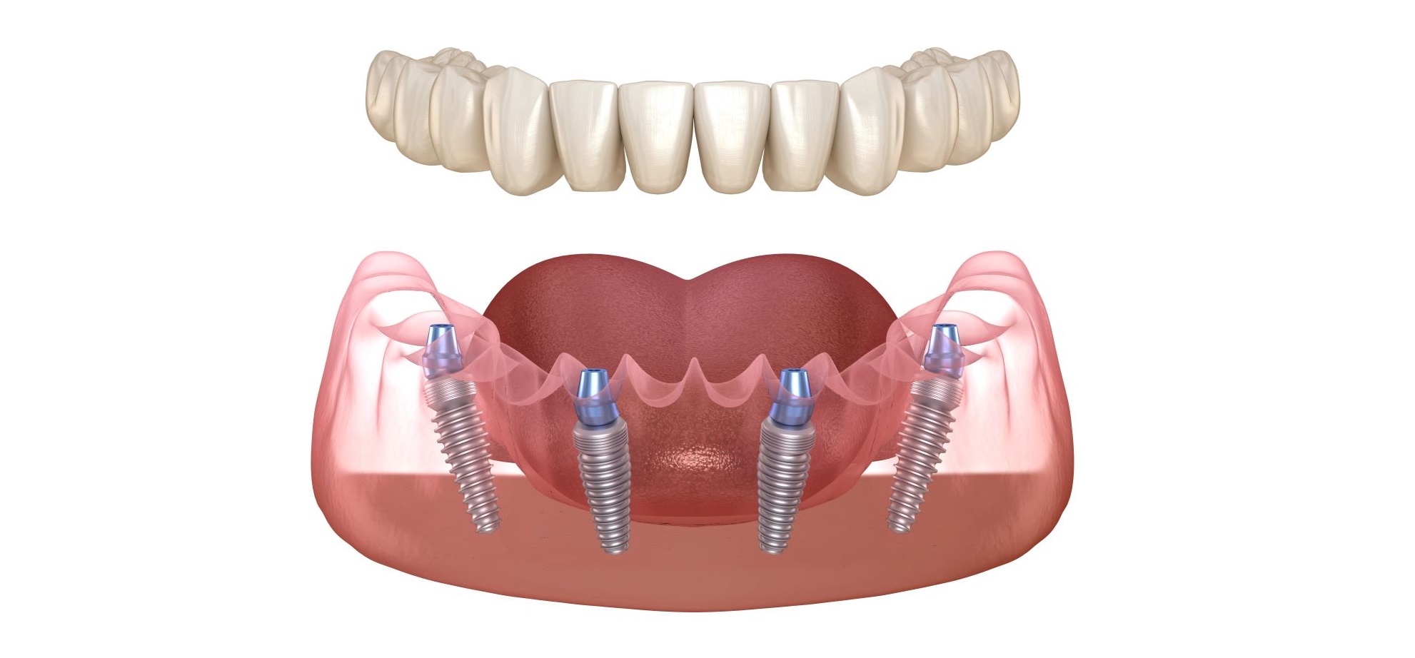 All-on-4 Dental Implants in Istanbul