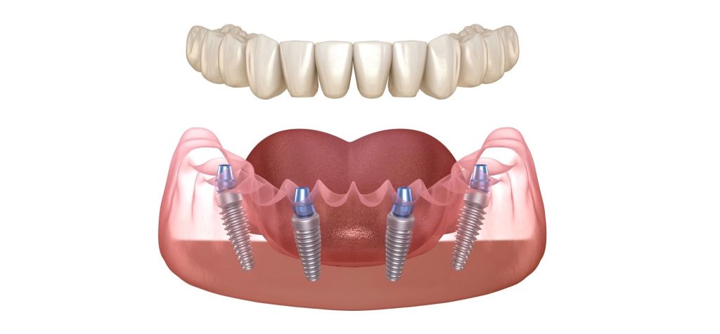 All-on-4 Dental Implants in Istanbul