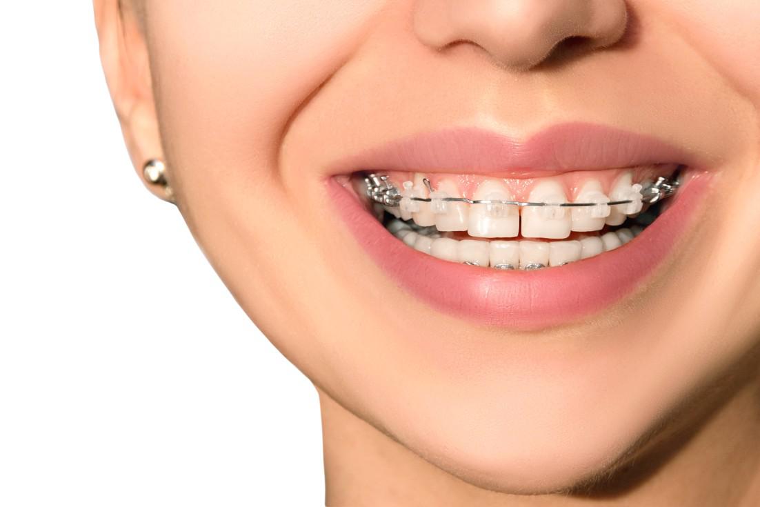 Braces Installation in Istanbul